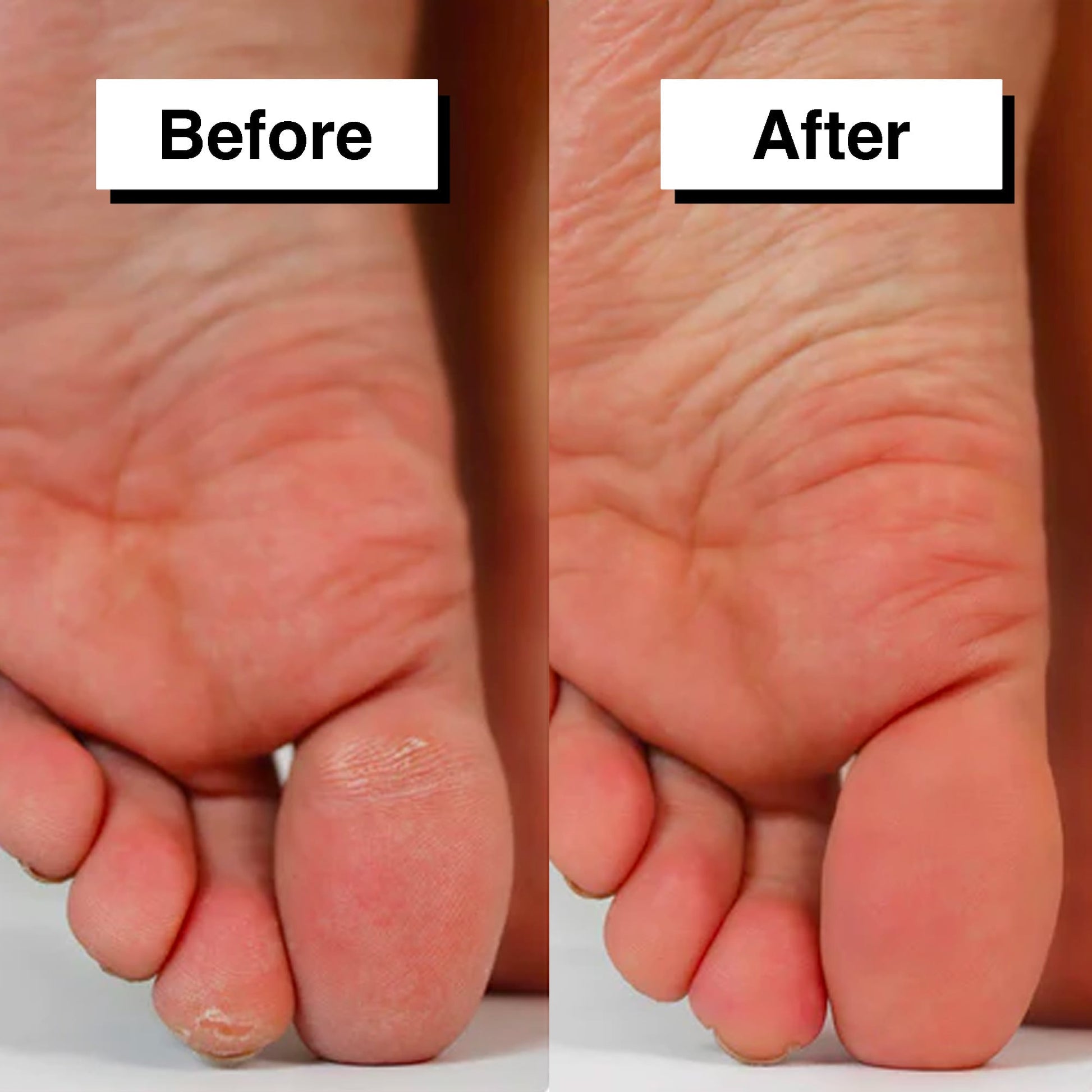 Pedicuure™: Automatic Callus Remover – Dr. Callus