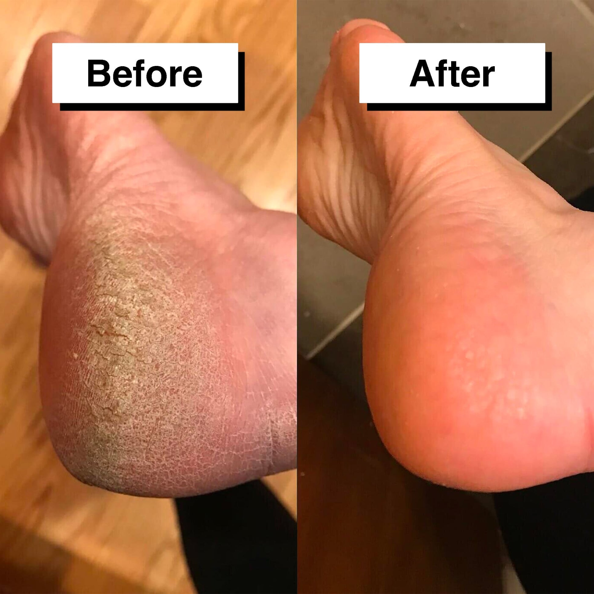 Pedicuure™: Automatic Callus Remover – Dr. Callus